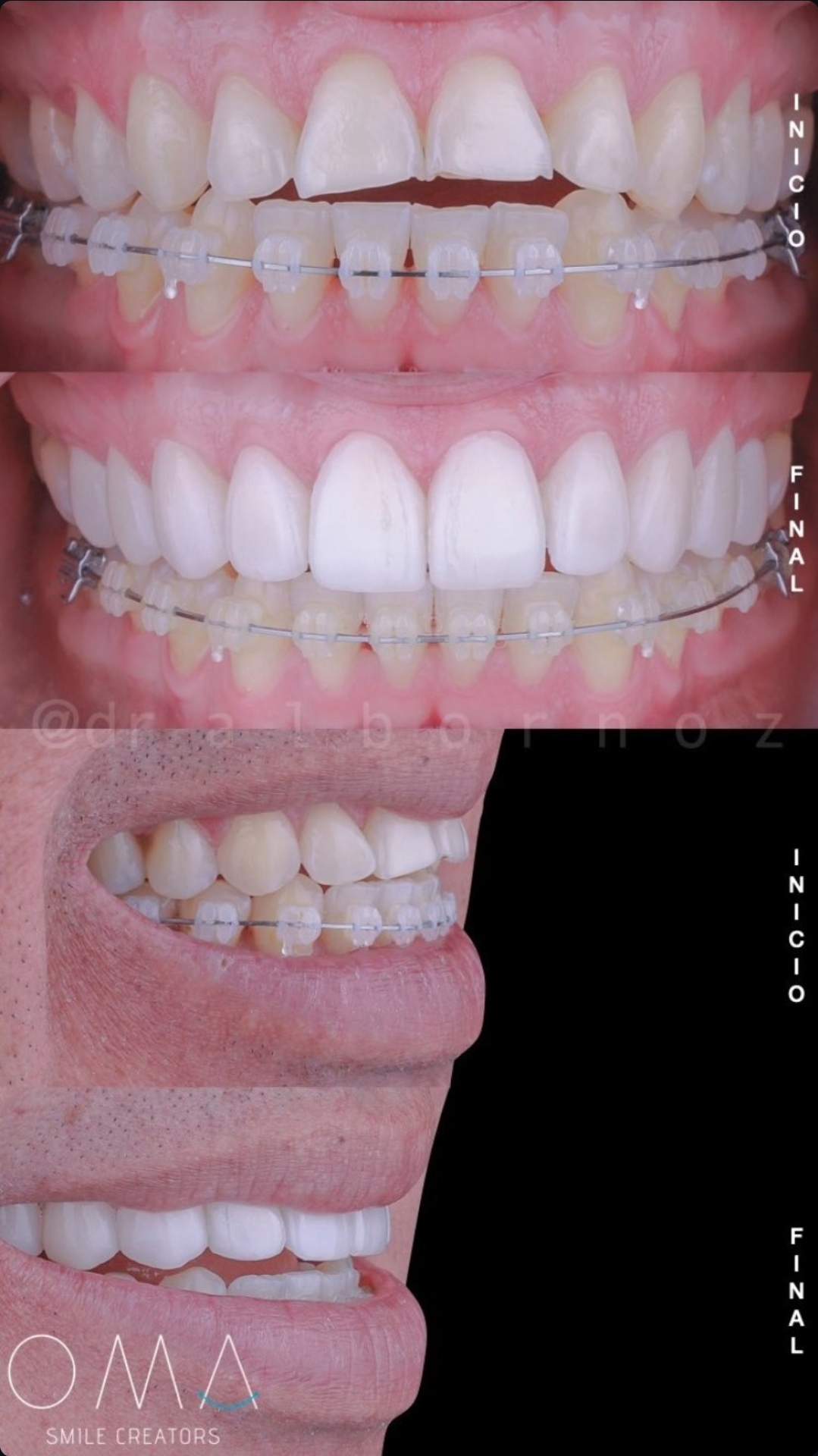 Diseño de sonrisa